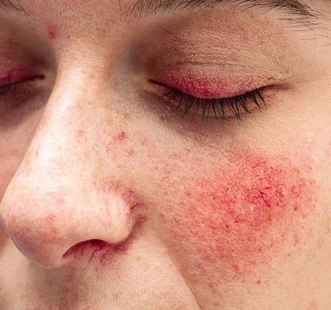 Close-up van roodheid en gevoelige huid